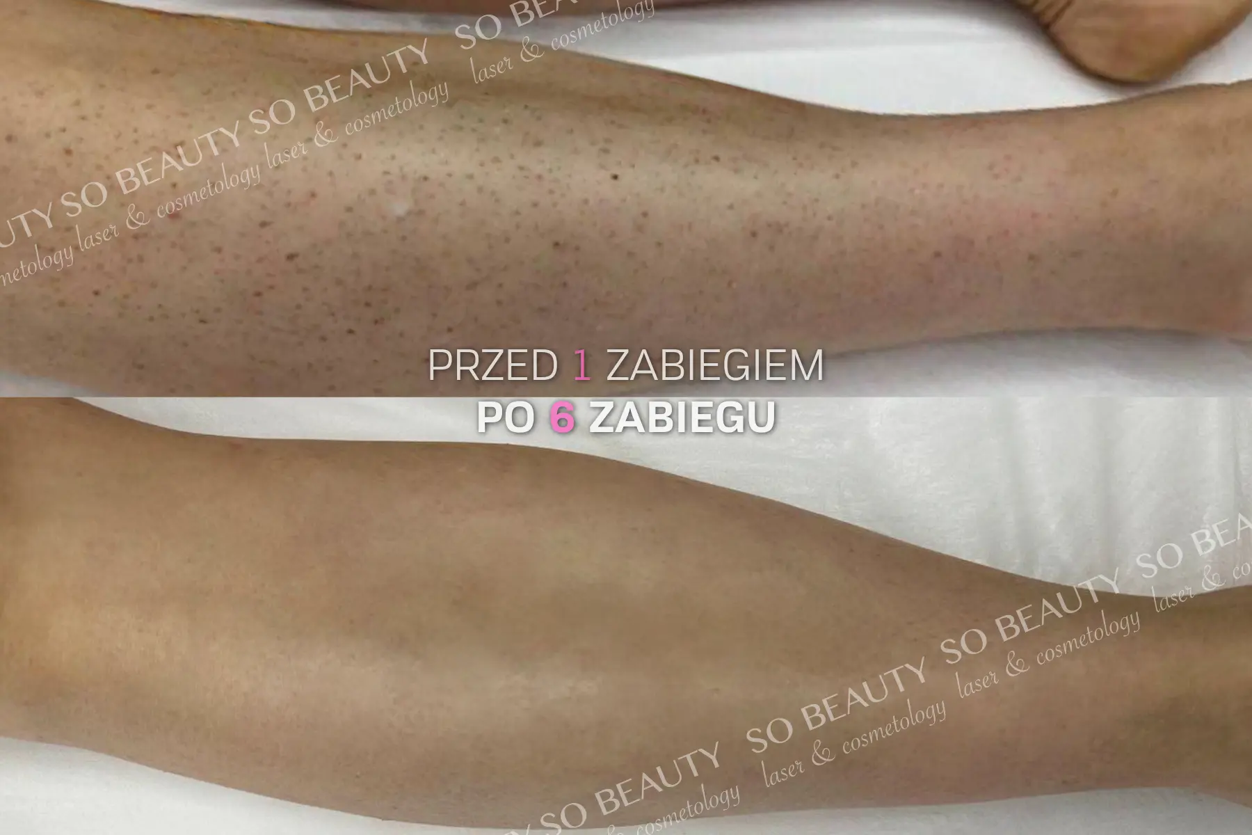 Nogi przed 1 zabiegiem i po 6 zabiegach depilacji laserowej