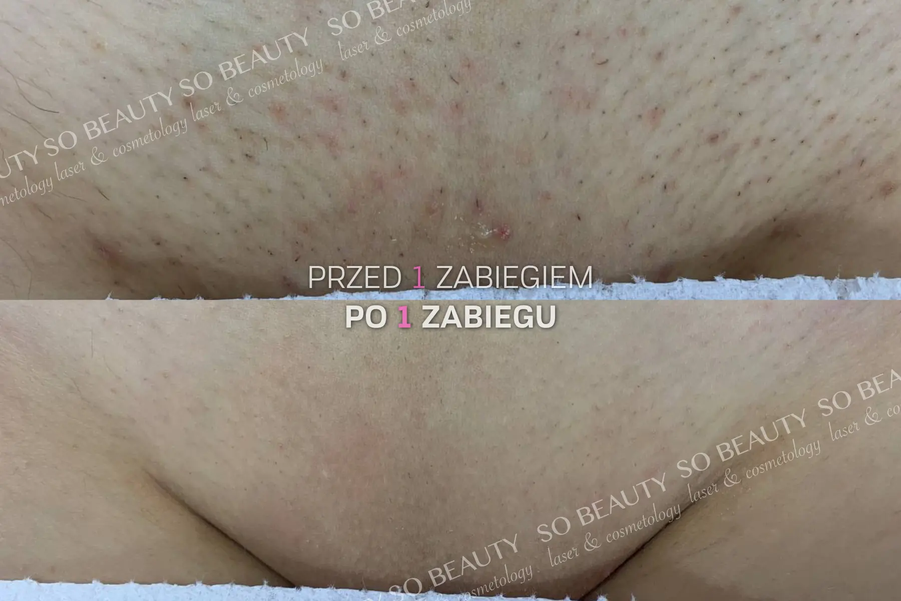 Bikini przed 1 zabiegiem i po 1 zabiegu depilacji laserowej