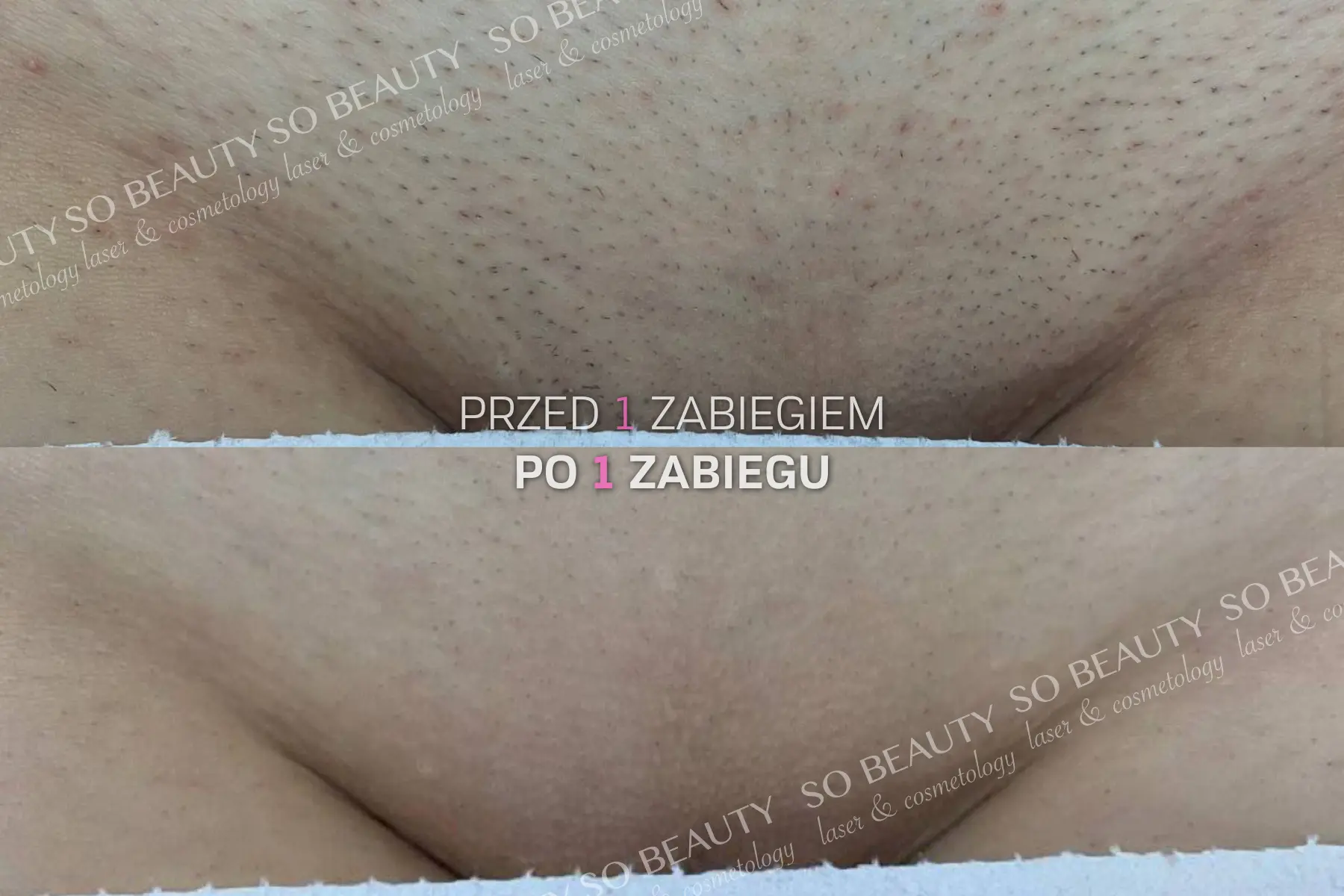Bikini przed 1 zabiegiem i po 1 zabiegu depilacji laserowej