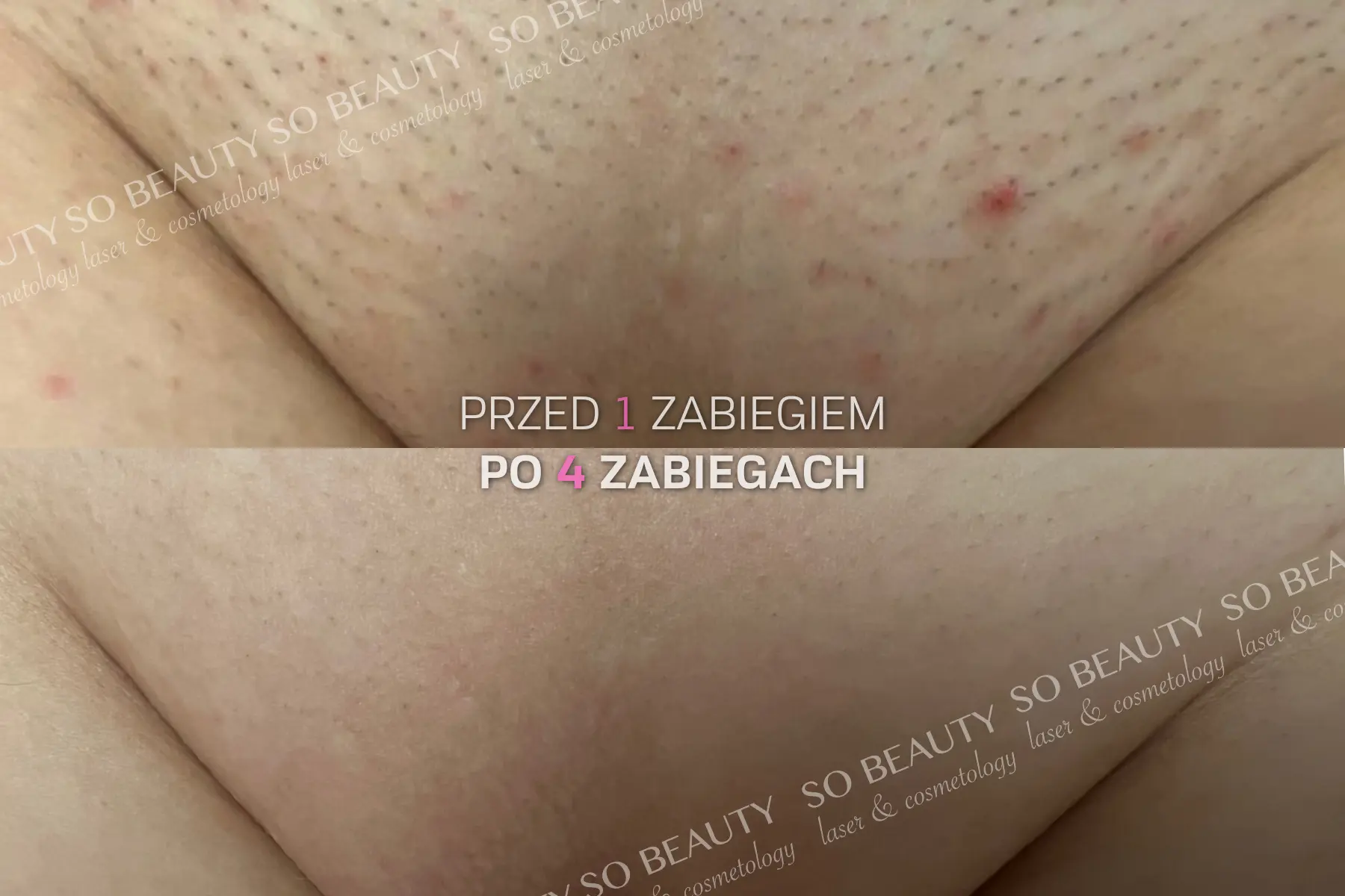 Bikini przed 1 zabiegiem i po 4 zabiegach depilacji laserowej