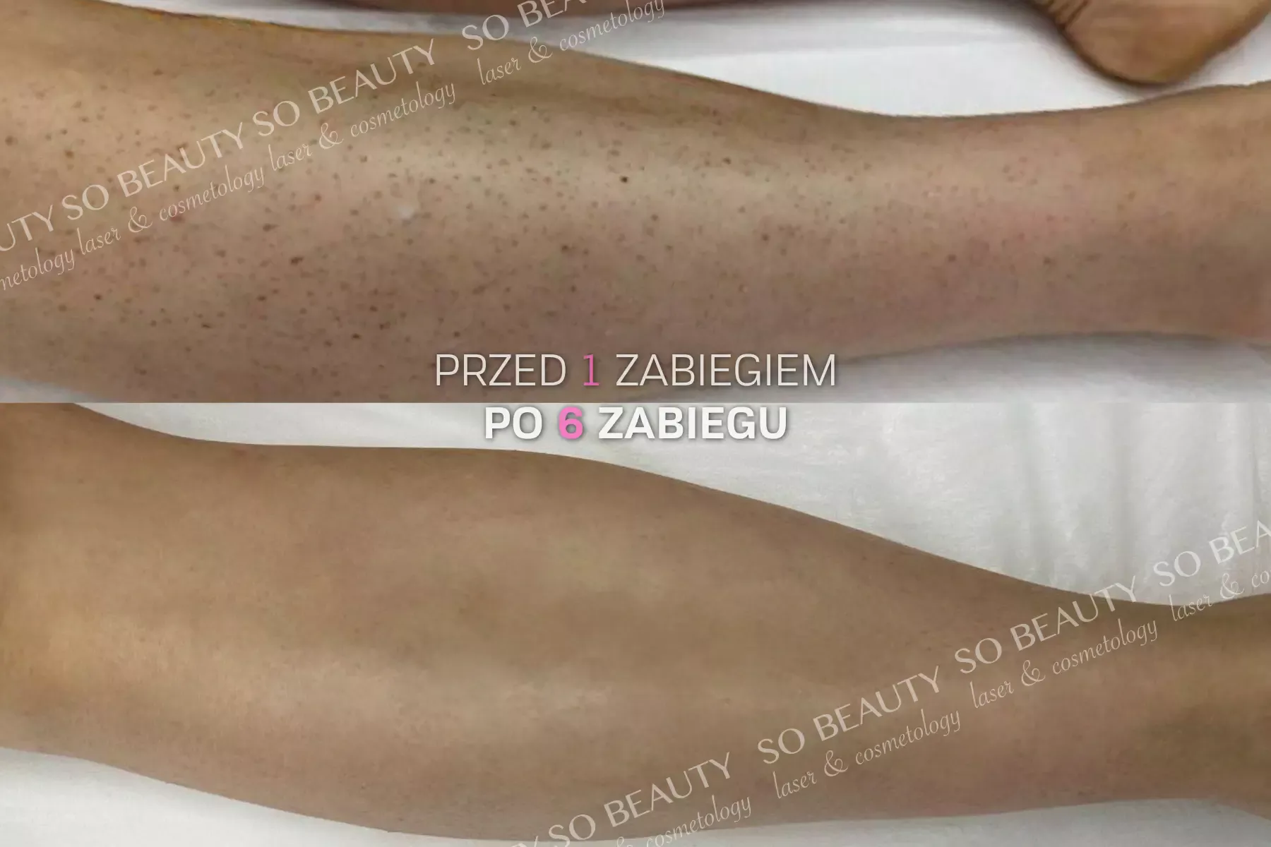 Nogi przed 1 zabiegiem i po 6 zabiegach depilacji laserowej
