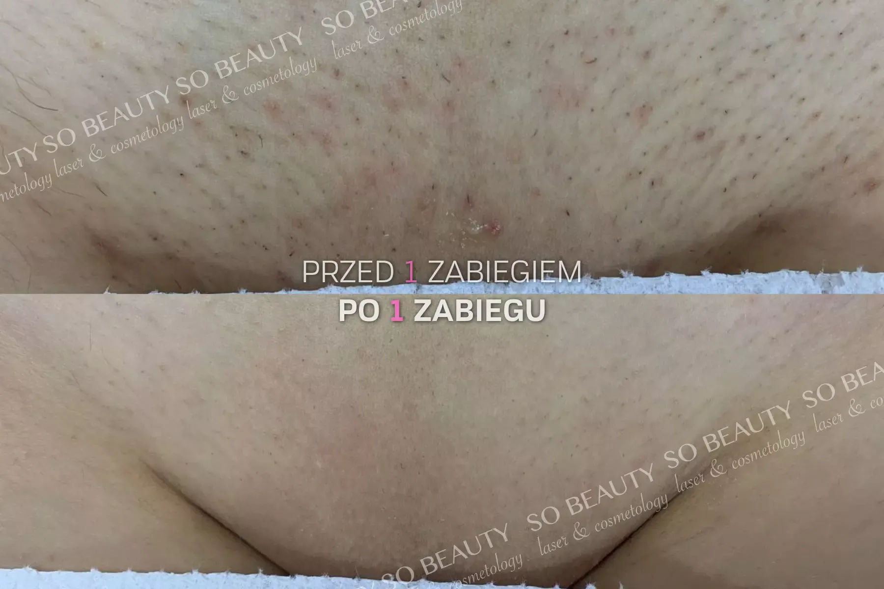 Bikini przed 1 zabiegiem i po 1 zabiegu depilacji laserowej