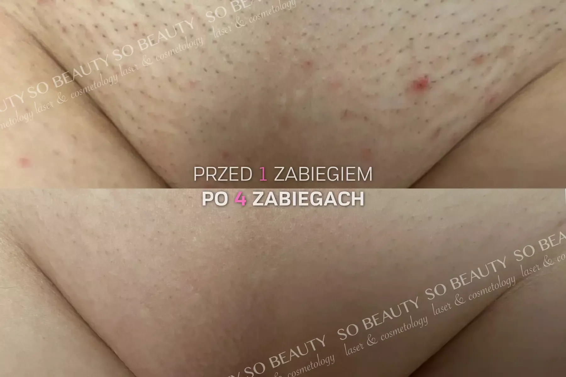 Bikini przed 1 zabiegiem i po 4 zabiegach depilacji laserowej