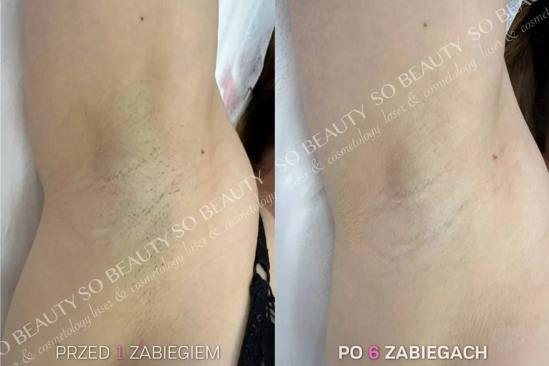 Pachy przed 1 zabiegiem i po 6 zabiegach depilacji laserowej