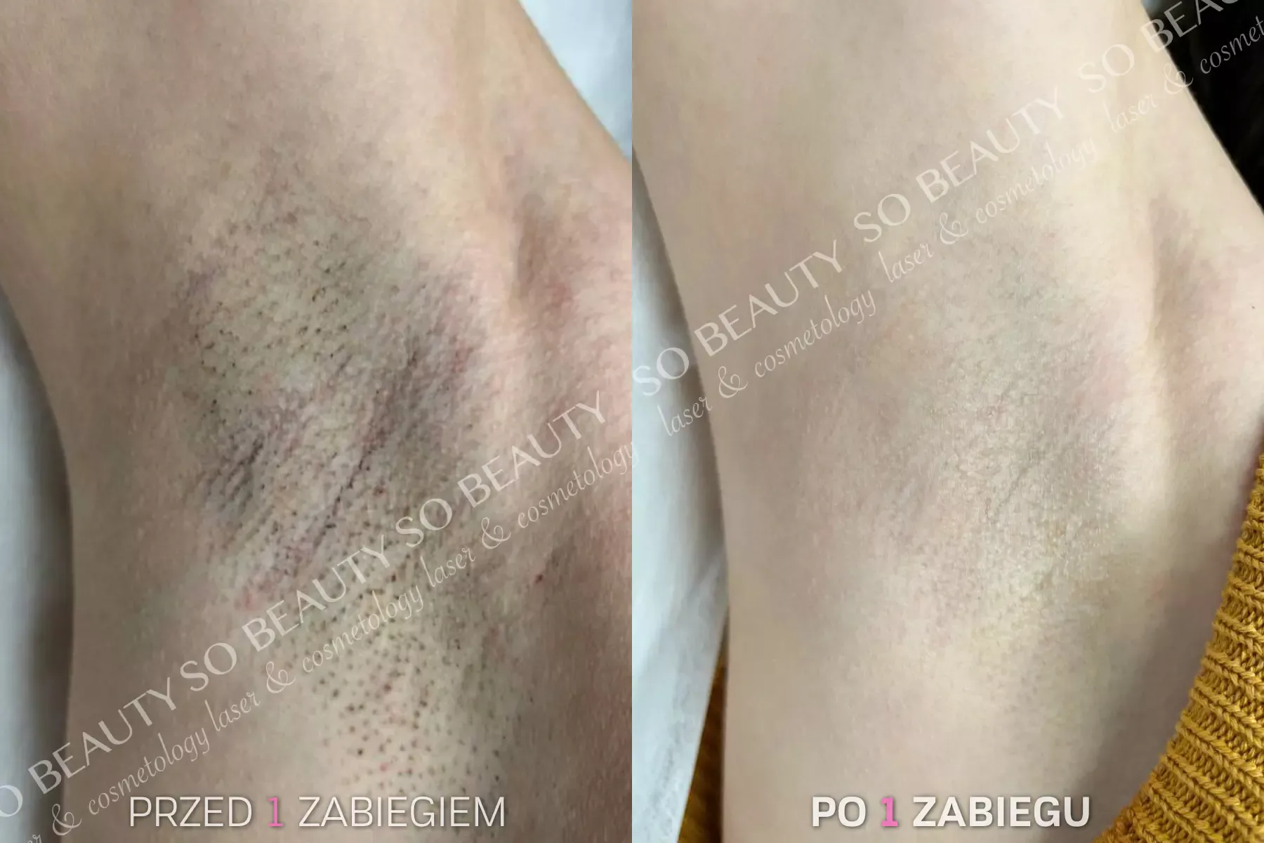 Pachy przed 1 zabiegiem i po 1 zabiegu depilacji laserowej