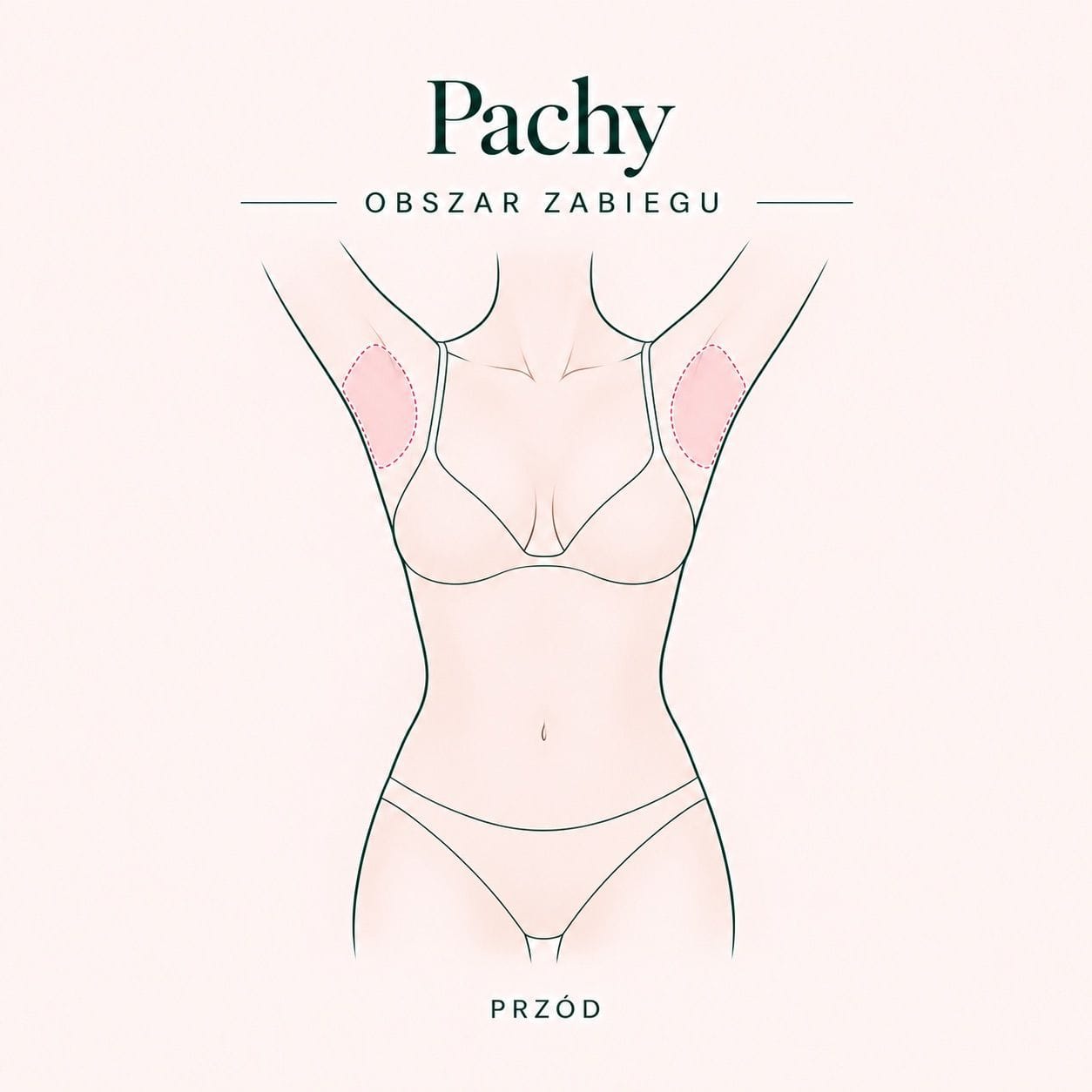 Schemat zabiegu: pachy — obszar zabiegu